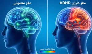 تفاوت اسکن مغزی و اهمیت تشخیص ADHD در بزرگسالان.
